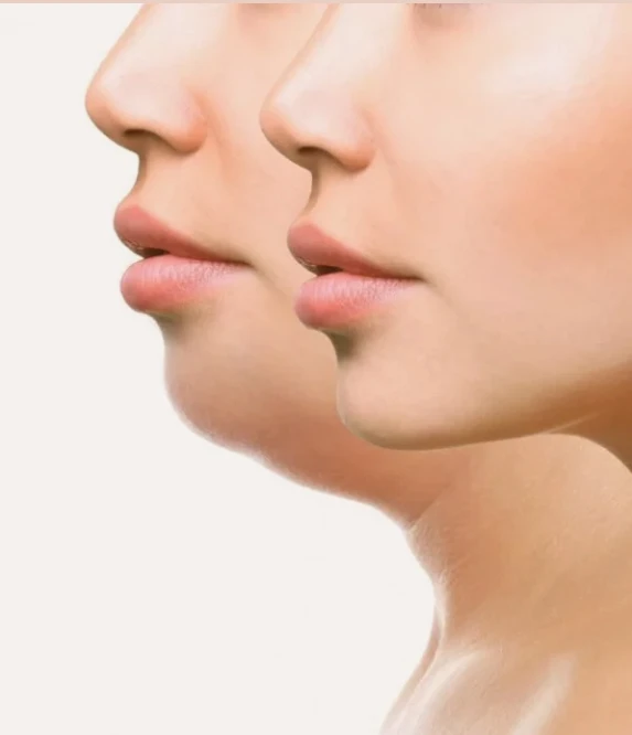 Facial Contouring